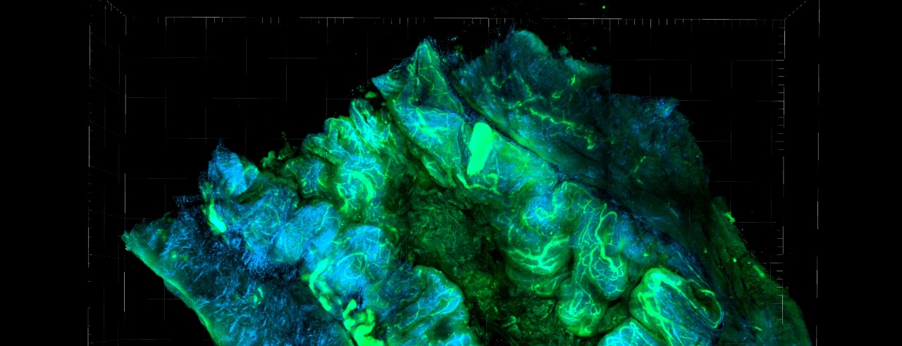 A stained ovarian cancer tumor from an animal model