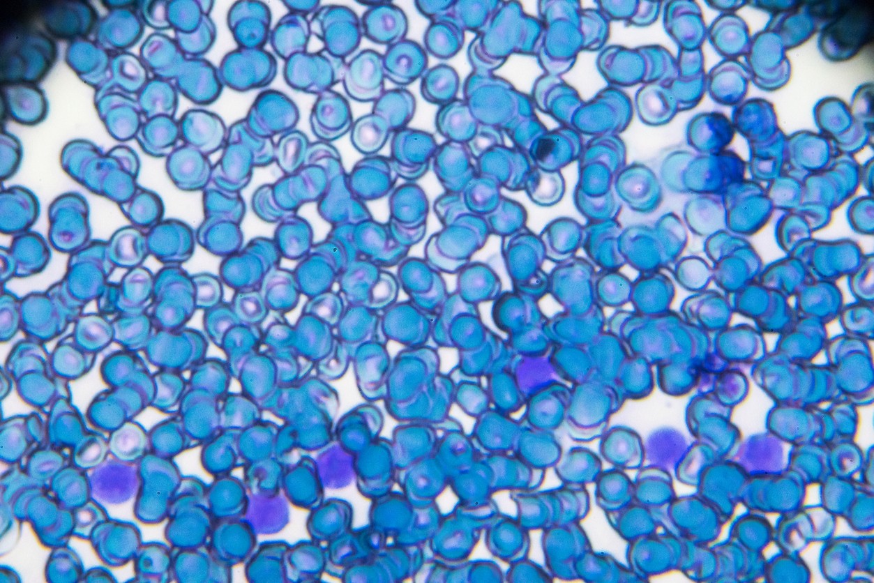 Acute lymphoblastic leukemia cells dyed blue viewed under a microscope