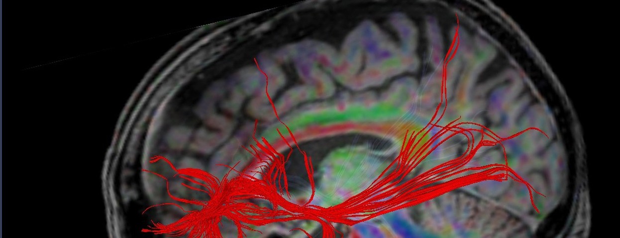 A brain image with different colors showing white matter connectivity