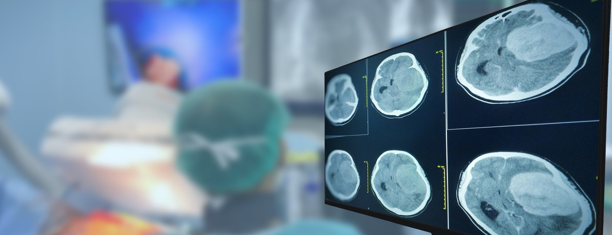 A CT brain scan showing a brain tumor on a computer monitor, with medical professionals working in the background