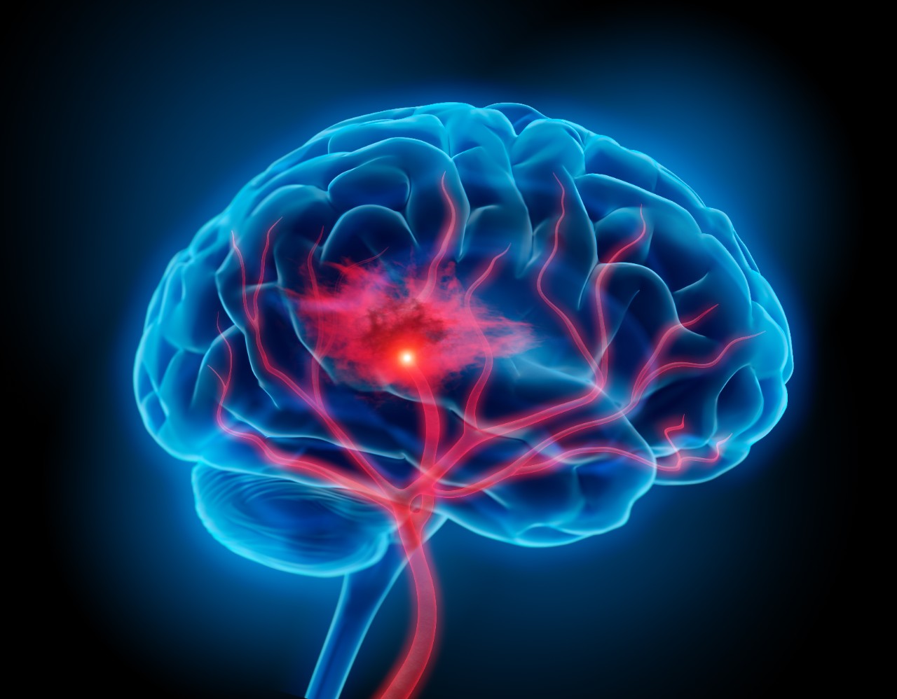 An illustration of a brain with stroke symptoms