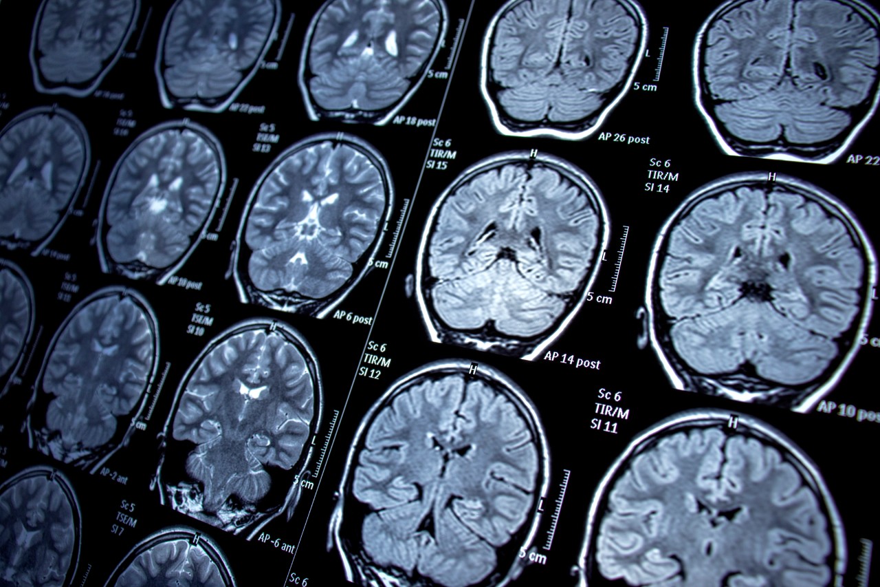 Brain scans on a monitor