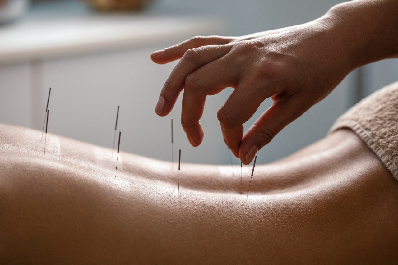 a photo of a woman lying on her stomach with acupuncture needles in her back