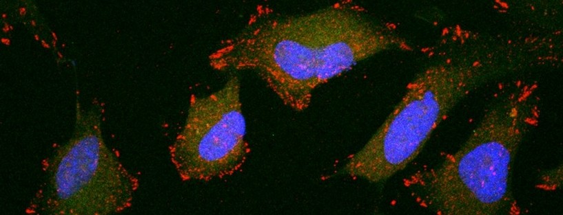 A microscopic image of cervical cancer cells metastasizing 