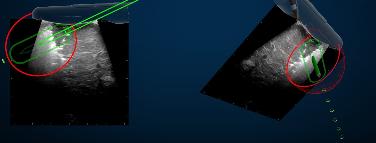 A navigation display with a green pointer and red circle pointing to the location of a liver tumor on an ultrasound image