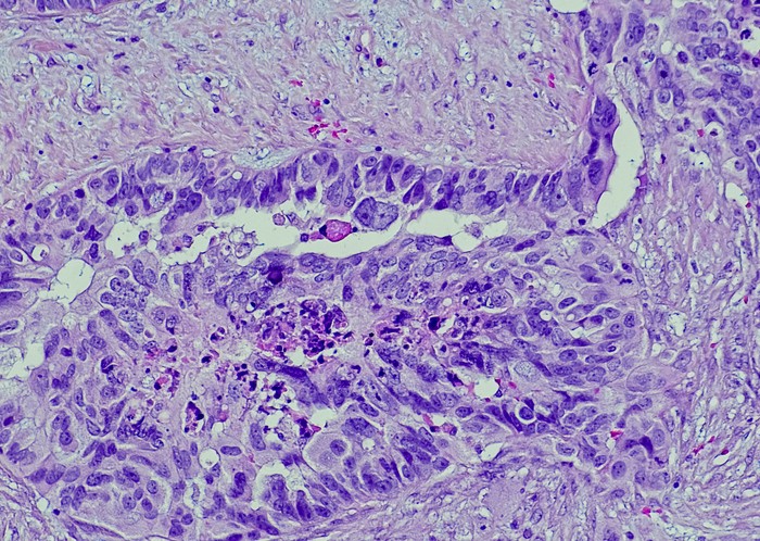 Ovarian cancer cells