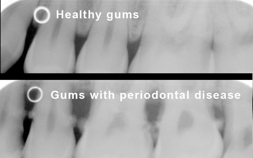 This photo shows healthy gums and the gums of someone with periodontal, or gum, disease. Research has shown gum disease can contribute to heart problems.