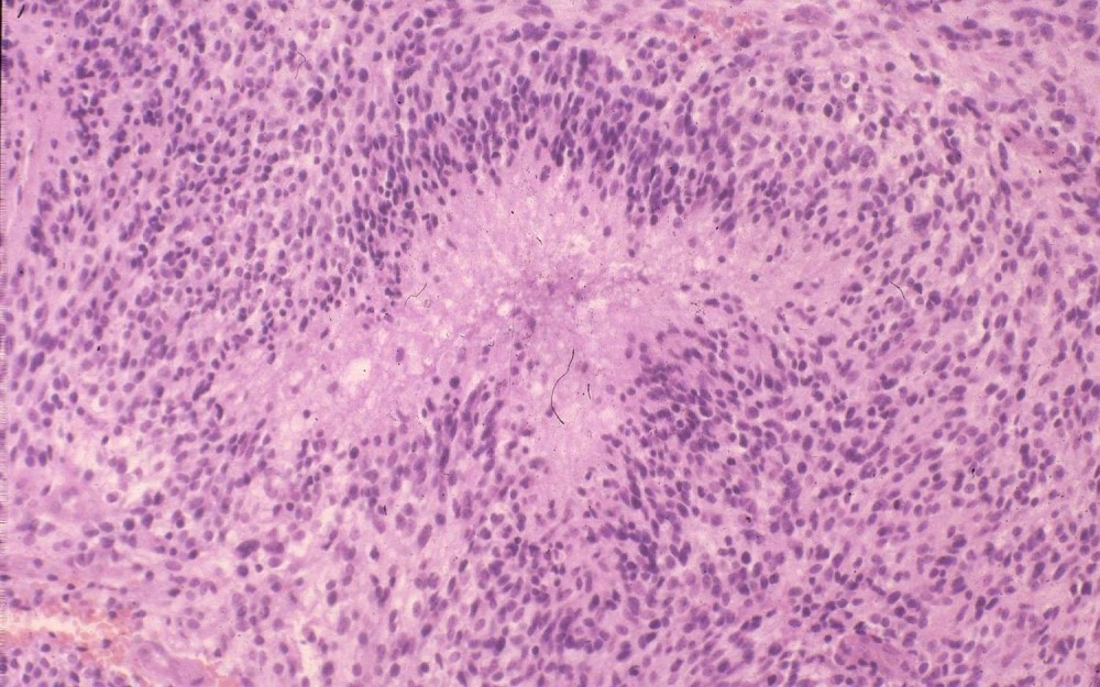 Glioblastoma multiforme tumors, shown here under a microscope, are an aggressive form of brain cancer. 