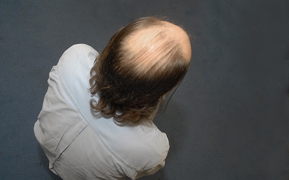 Alopecia, known commonly as pattern baldness, affects more men than women.