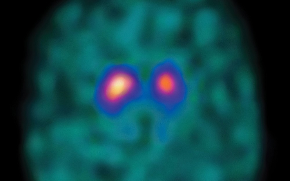 A DaTscan image, showing abnormal dopamine activity in the brain. 