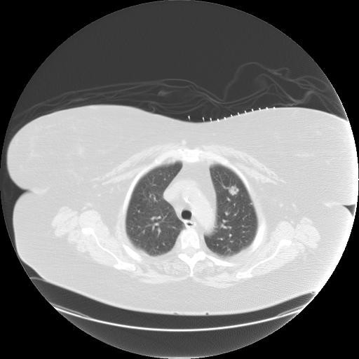 Screening is done with a low-dose CT scan that creates a 3-D image of the lungs, such as this example.