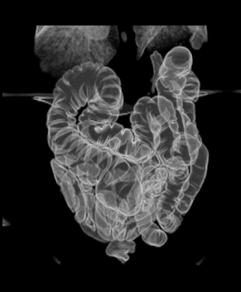 This dual-contrast image of the large intestine is used to cross-reference problem areas identified on CT scans.